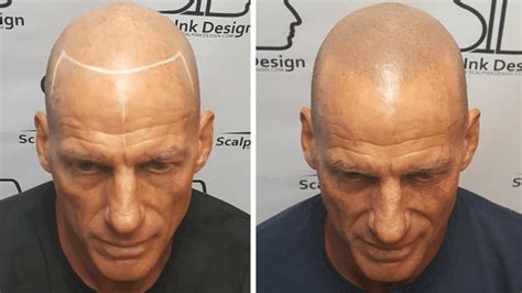 colmek+smp|Scalp Micropigmentation in Miami 